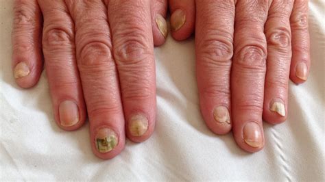 hand nail fungus
