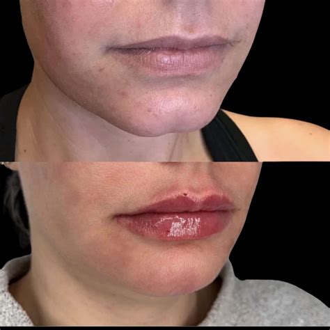 restylane lyft for lips 6
