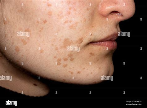 disseminated flat warts verruca plana   skin   face