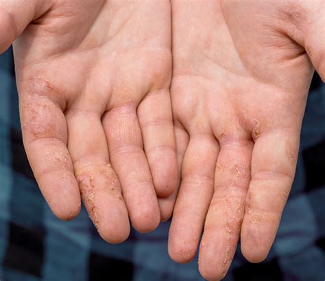 Dyshidrotic Eczema Fingers