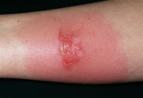 infected burn photograph  dr p marazziscience photo library
