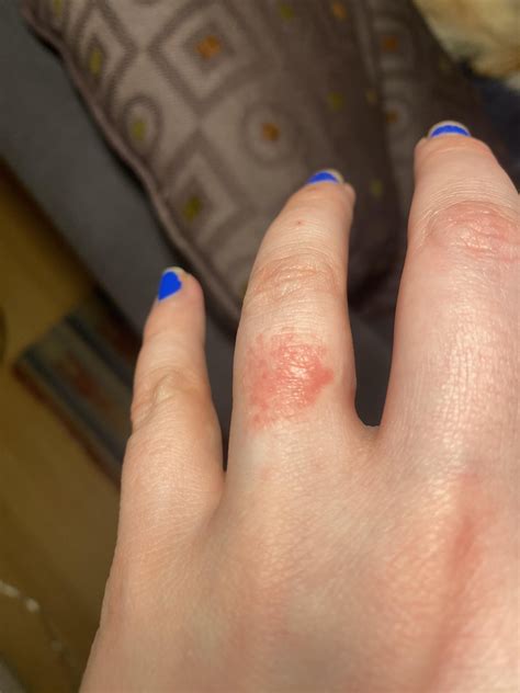 is this ring rash? : r/DermatologyQuestions