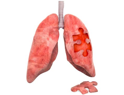 Lung transplant surgery