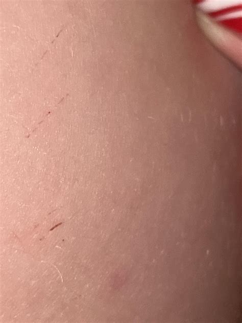 Scabies or Something else? my 2 year old has been itching his whole