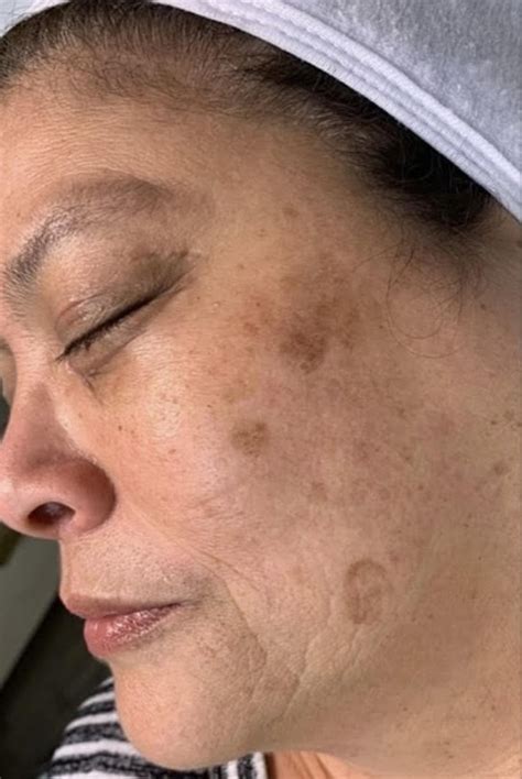 Hyperpigmentation Correction Archives - The Glow Clinic