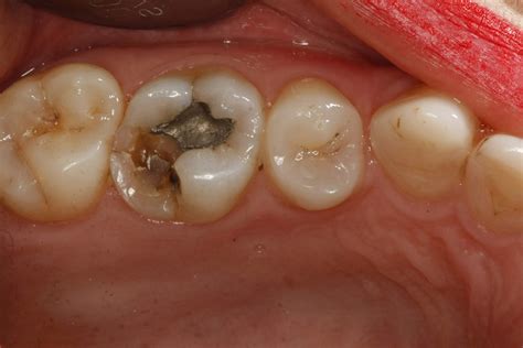 Broken Molar