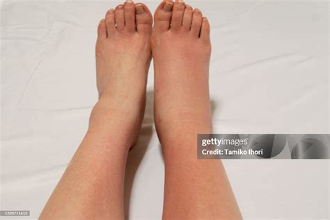leg   symptom  bacterial cellulitis high res stock photo