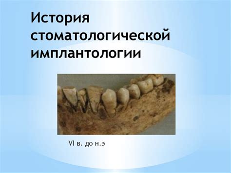 Основы имплантации в стоматологии - презентация онлайн