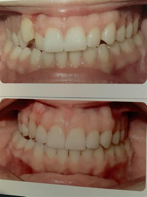 Finished today and attachments removed- I’ve been told I need to wear
