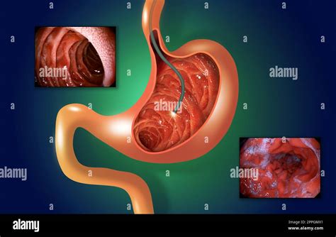 Digestive endoscopy or gastroscopy. Performing a gastroscopy procedure ...