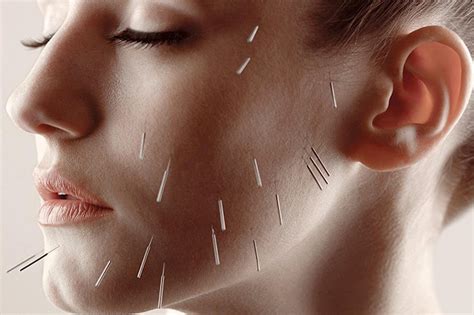 facial acupuncture  york facial body rejuvenation