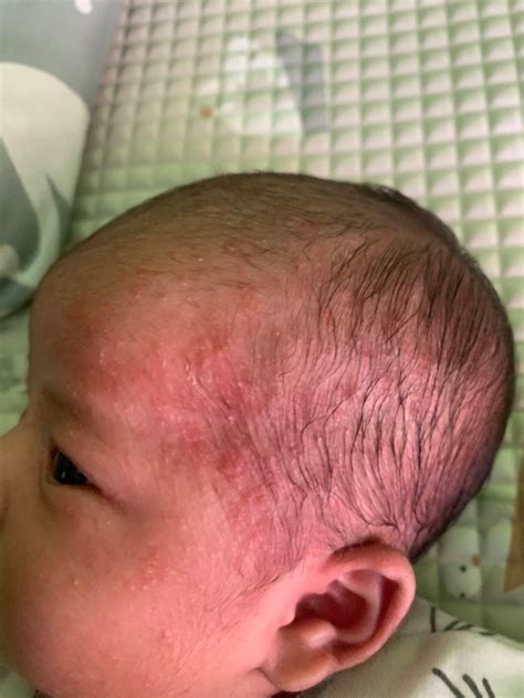 ruam bintik bintik merah hellosehat