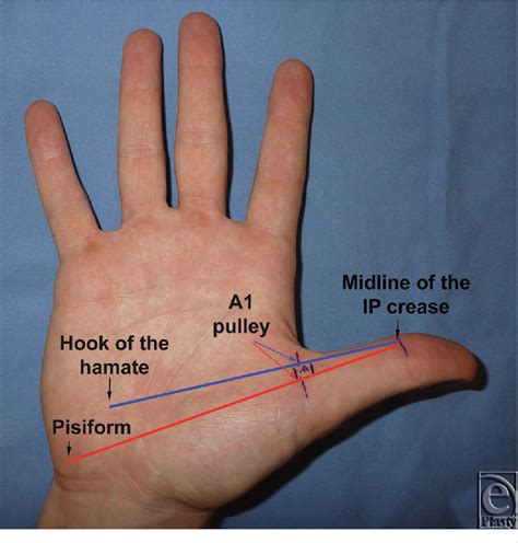 safe treatment  trigger thumb  longitudinal anatomic