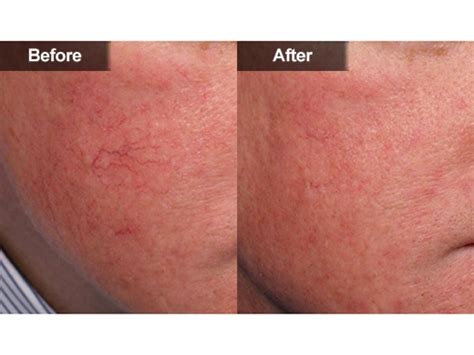 Red Spots & Vein Removal | McLean & Woodbridge Virginia | Skin & Laser ...