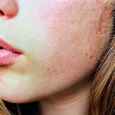 Polycythemia Vera Skin Conditions: Causes and Treatments