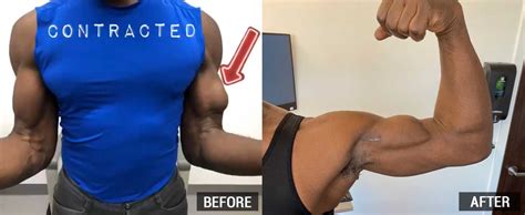 Biceps Tendon Tear Treatment | Proximal Biceps Tear & Distal Biceps ...