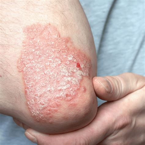 Psoriasis | The Recovery Hub Adelaide
