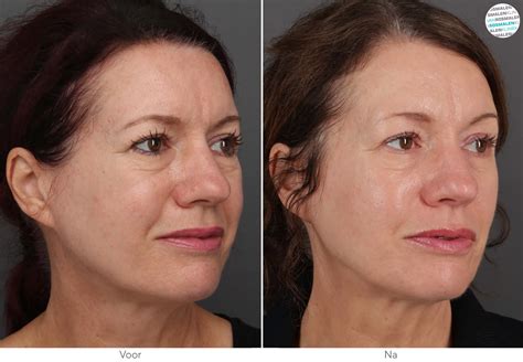 Voor en na foto's van diverse behandelingen | Van Rosmalen Kliniek