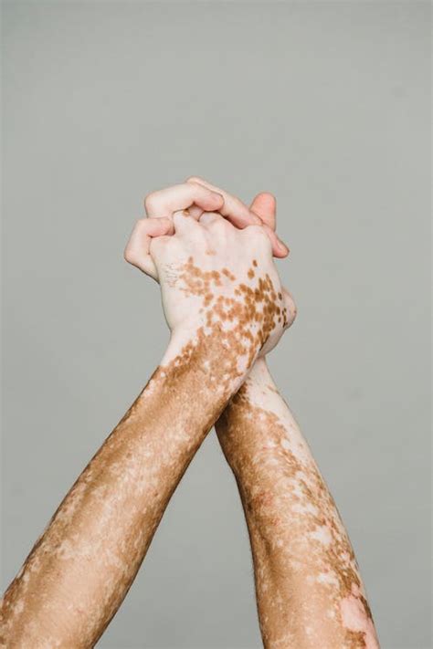 Crossed hands with vitiligo skin against gray background · Free Stock Photo