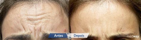 Como Prolongar O Efeito Do Botox - Tudo o que precisa de saber sobre o efeito do botox na face