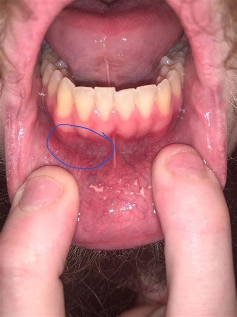 Possible small white bump? I’m not quite sure what it is. : r/askdentists