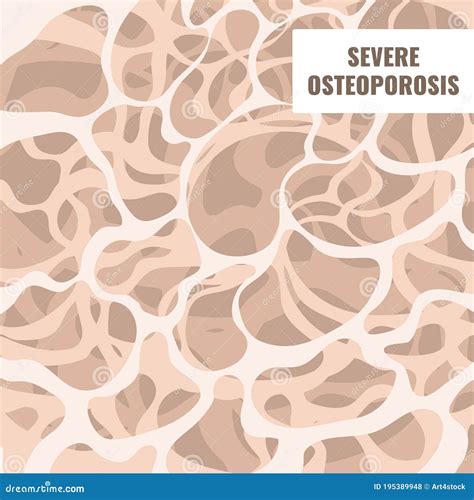 Osteoporosis Bone Density Loss Disease Medical Infographics Stock