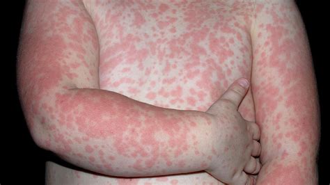 Red Dry Skin Rash at Mary Massingill blog