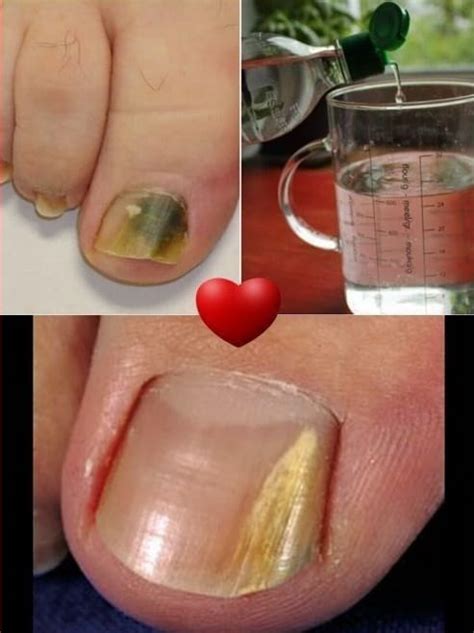 DESHAZTE DE LOS HONGOS DE LAS UÑAS CON ESTE REMEDIO DE 2 INGREDIENTES ...