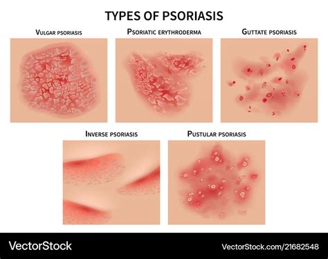 Psoriasis types skin hives derma diseases Vector Image