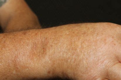 scleroderma   treatment brentwood dermatology