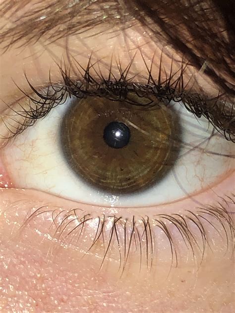brown  amber    central heterochromia reyes