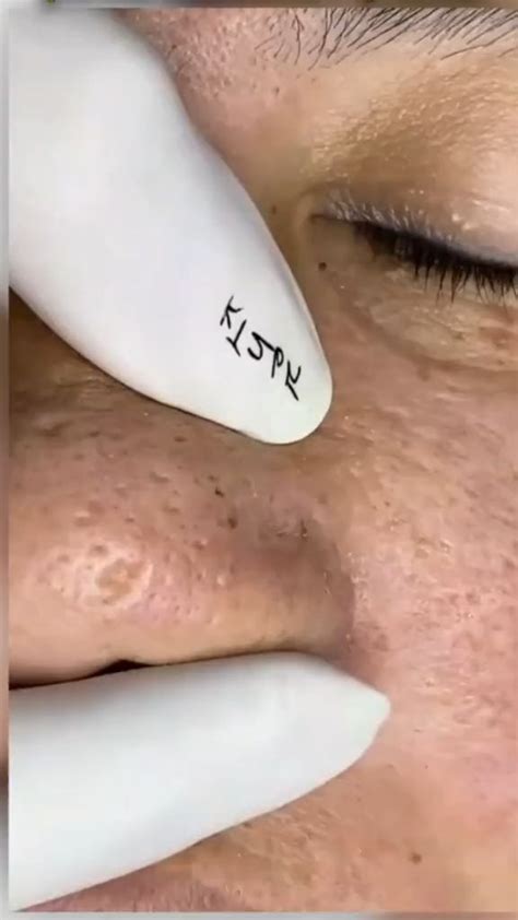 The Future of Skin Care? Unbelievable Blackhead Removal 2024 Explained - howyvgc