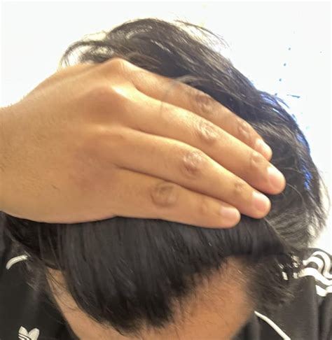 Finasteride 6 month Progress. Started Oct 4. Dose: .25 mg Everyday or ...