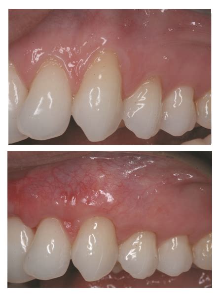 Dental Implants Before and After | Heritage Dental Specialists