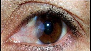 mong thit   phau thuat som benh vien mat sai gon