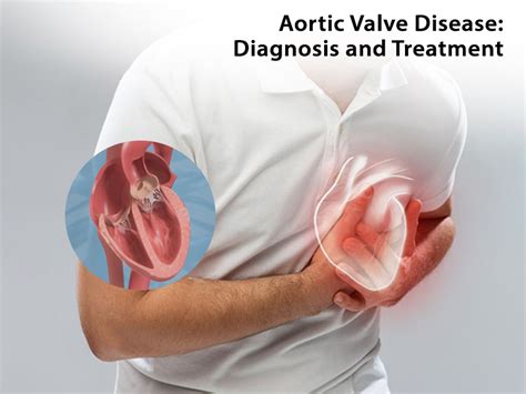 aortic valve disease diagnosis  treatment   newtown clinic