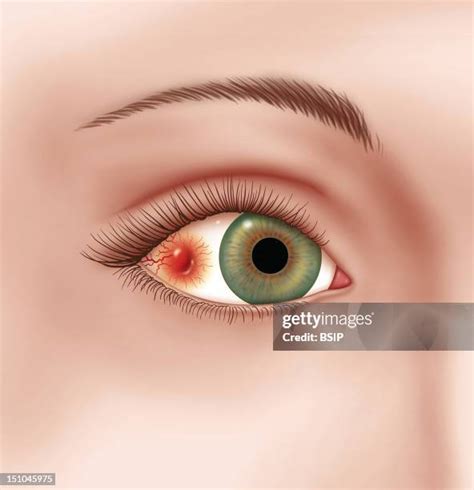 Anterior Scleritis Photos and Premium High Res Pictures - Getty Images