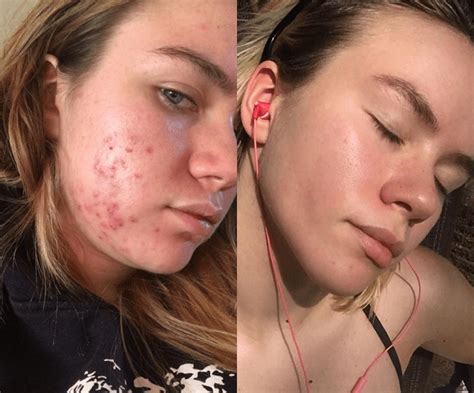 Everything to Know About Spironolactone For Acne—From Results to Side ...