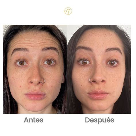 botox fotos antes  despues de toxina botulinica