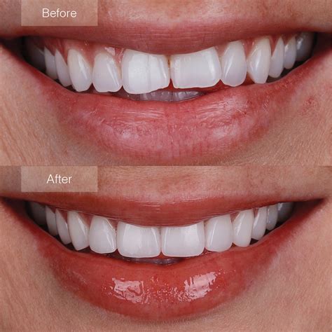 Process Of Veneers at Rachel Pak blog