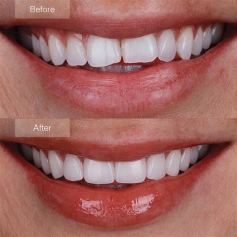 Teeth Before And After Veneers