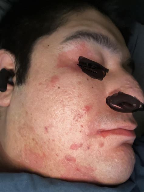 Benzoyl Peroxide Burn? : r/Skincare_Addiction