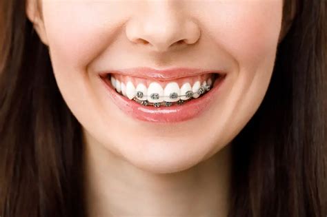 reasons  traditional braces    option   merit