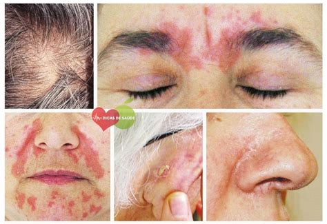 O Que Causa Dermatite Seborreica - Dermatite Seborreica - O que é, Causas, Sintomas e Tratamento | Dicas ...