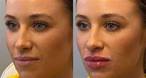 What Does Botox Lips Look Like | Lipstutorial.org