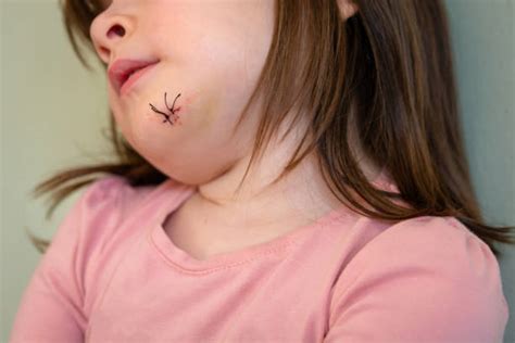 140+ Scar Stitches Human Face Surgery Stock Photos, Pictures & Royalty ...