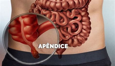 Qual A Função Da Apendice - Onde Fica O Apêndice – Apêndice: onde fica, o que é, função, anatomia ...
