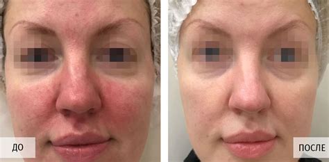 Лечение розацеа - STELLAR BEAUTY CLINIC