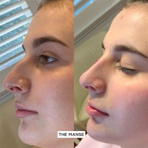 surgical nose treatments  cosmetic clinic sydney advanced