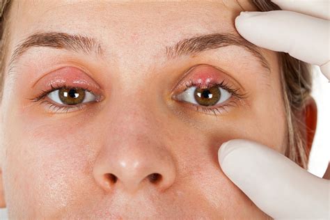 Eye Stye: Causes, Symptoms & Treatments | Eye Concepts